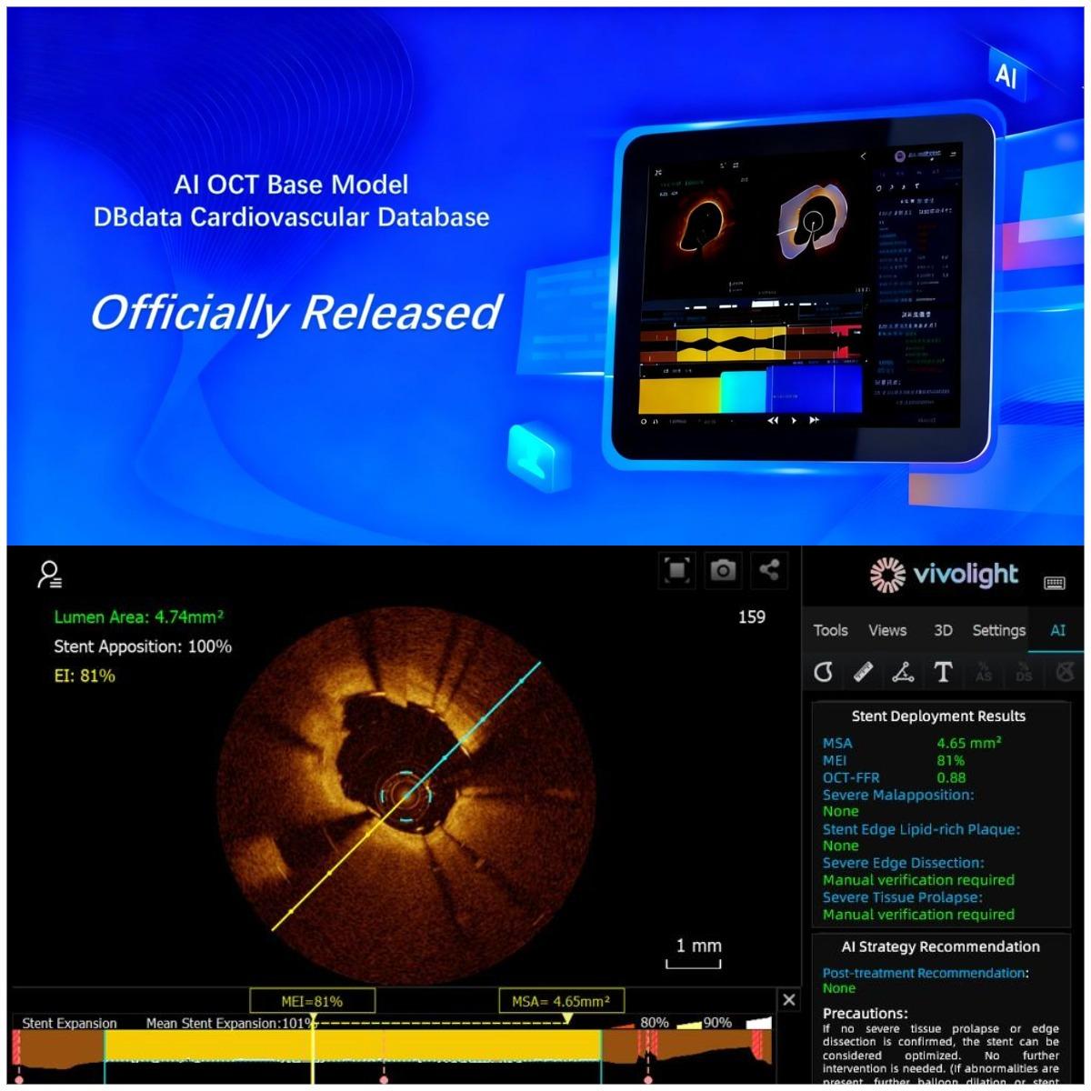 ¡No seguimos, definimos! La imagen intravascular en China entra en su era 